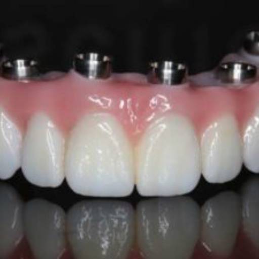 Implantes dentários em Resende, RJ por Clínica Torquato