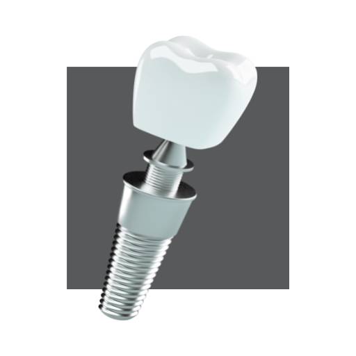 Implante Dentário por Nunes Odontologia