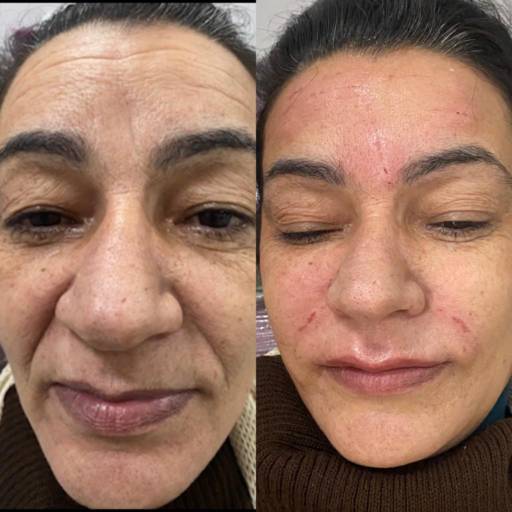 Harmonização Orofacial em Botucatu, SP por Dra Aline Faria - Odontologia Estética