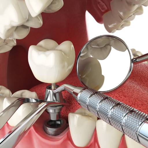 Implantes por Dr Julio Coelho - Odontologia