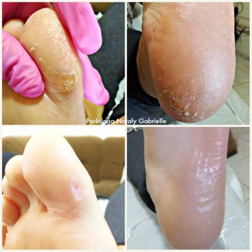 Calos e Calosidades por CliniPés | Podóloga Nataly Gabrielle