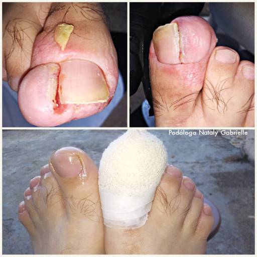 Unha Encravada por CliniPés | Podóloga Nataly Gabrielle