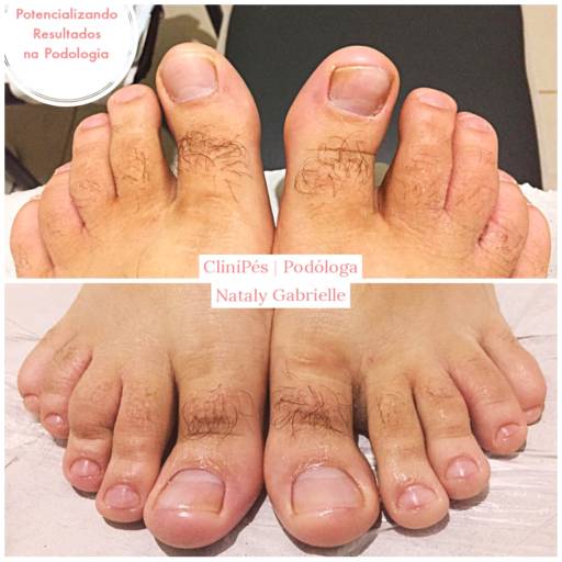 Podoprofilaxia por CliniPés | Podóloga Nataly Gabrielle