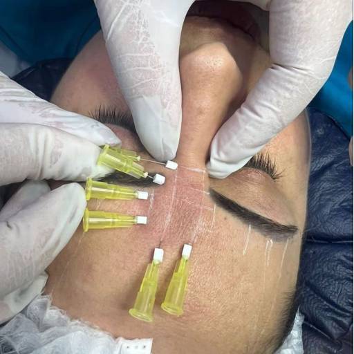 Aplicação de Botox