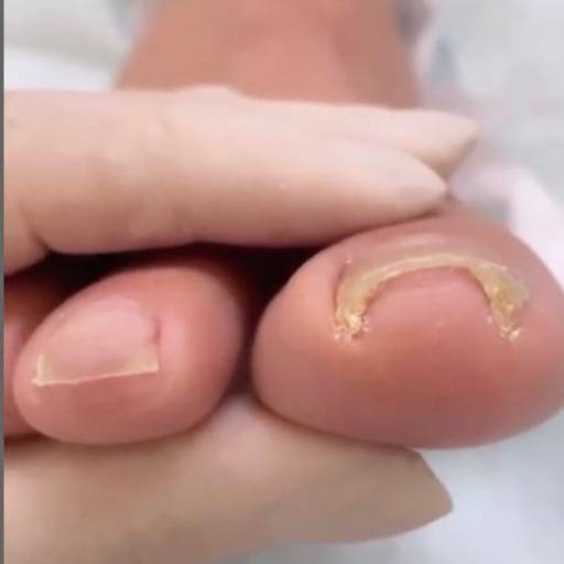 Tratamento de Unhas Encravadas por Alê Nogueira Podologia