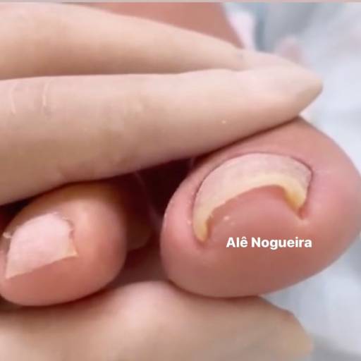 Tratamento de Unhas Encravadas por Alê Nogueira Podologia