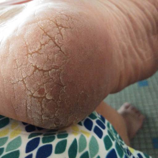 Tratamento de Rachaduras