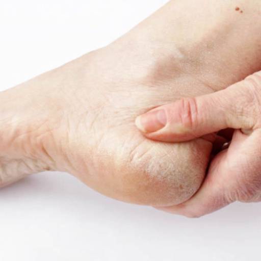 Tratamento de Ceratodermias