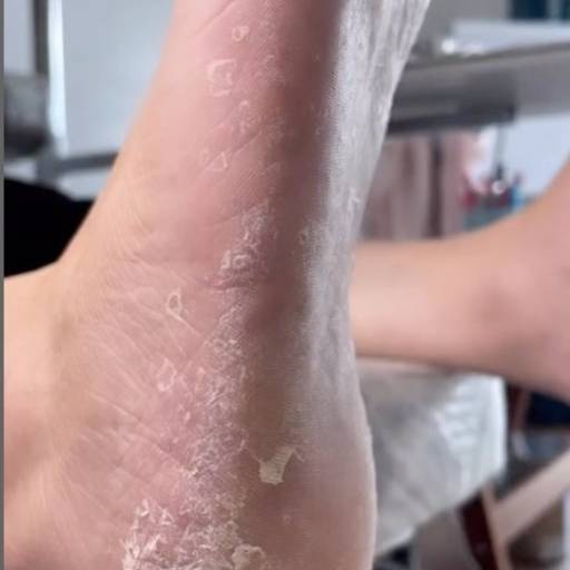 Tratamentos de Frieiras e Micoses 