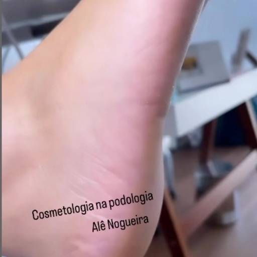 Tratamentos de Frieiras e Micoses  por Alê Nogueira Podologia