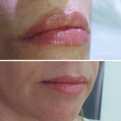 Preenchimento labial por Vivare Preenchimento labial por Vivare