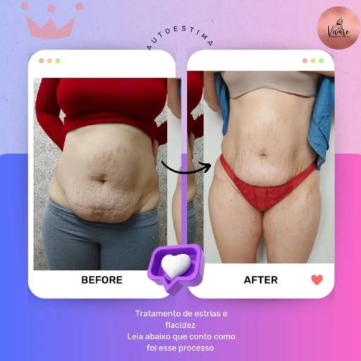 Tratamento para estrias