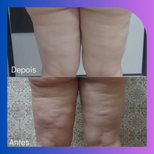 Tratamento de celulites