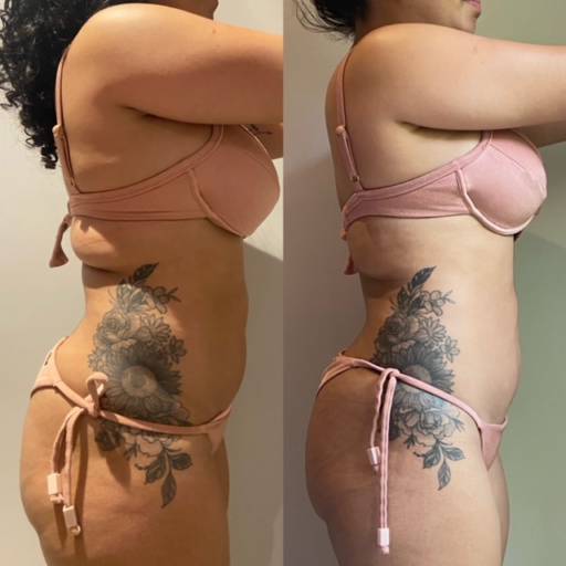 Lipo Enzimática por Anne Estética
