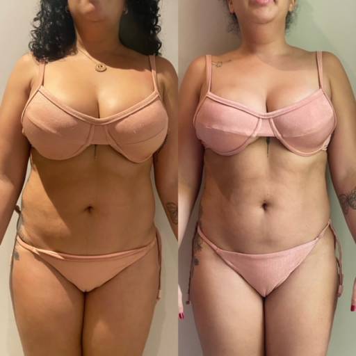 Lipo Enzimática por Anne Estética