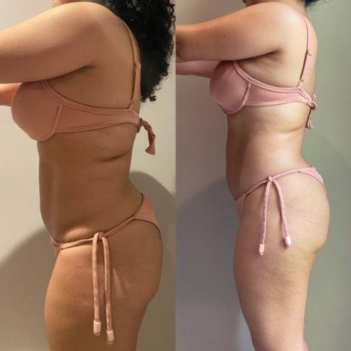 Lipo Enzimática por Anne Estética
