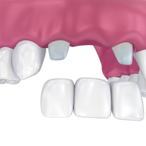 Ponte Fixa - Solução Duradoura para Dentes Perdidos em Colatina
