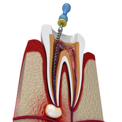 Endodontia (canal) por Medeiros Odontologia