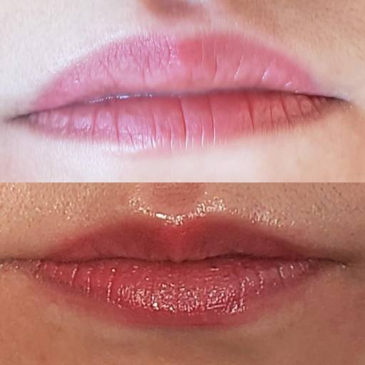 Hidra lyps em Bauru por Regina Castro Beauty