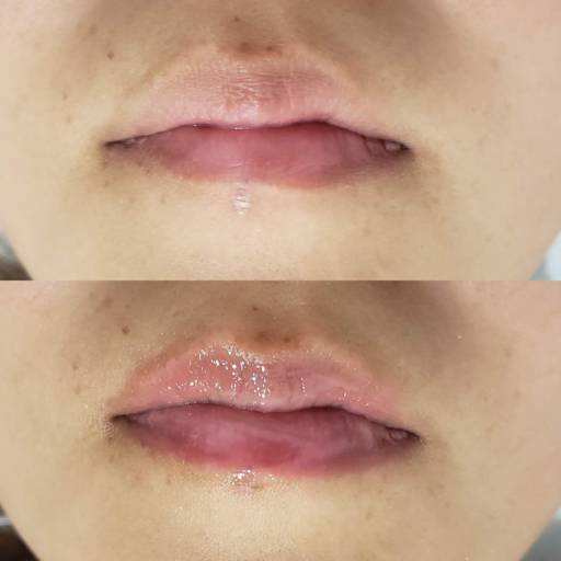 Hidra lyps em Bauru por Regina Castro Beauty