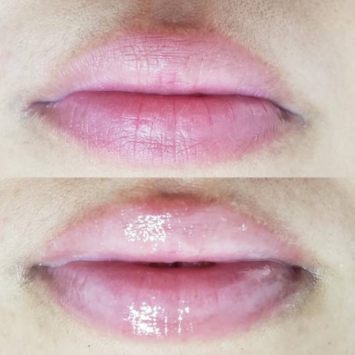 Hidra lyps em Bauru por Regina Castro Beauty