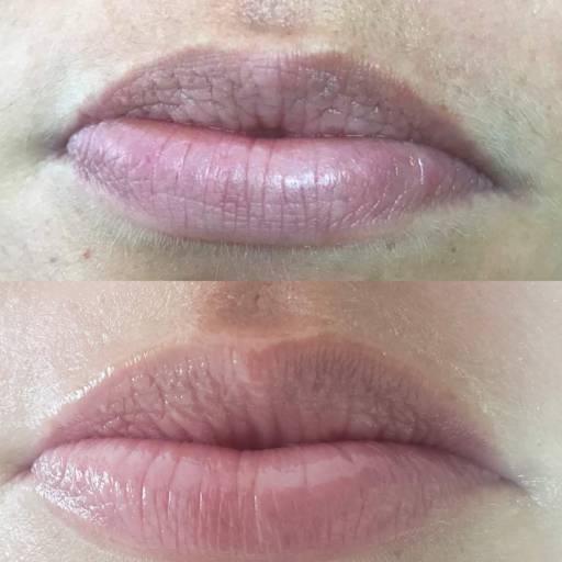 Hidra lyps em Bauru por Regina Castro Beauty