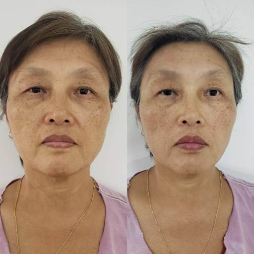 Toxina botulínica (botox) em Bauru