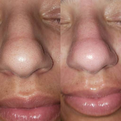 Limpeza de Pele em Bauru