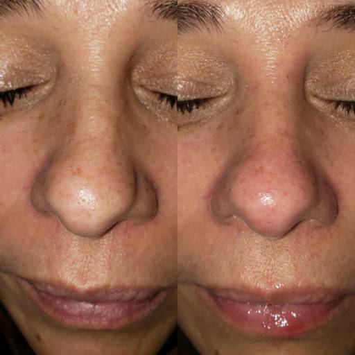 Limpeza de Pele em Bauru por Regina Castro Beauty