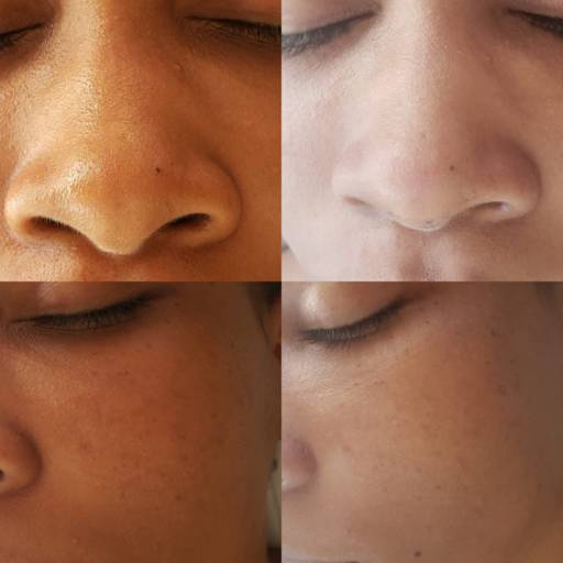 Limpeza de Pele em Bauru por Regina Castro Beauty