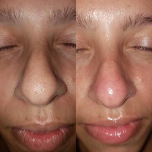 Limpeza de Pele em Bauru por Regina Castro Beauty