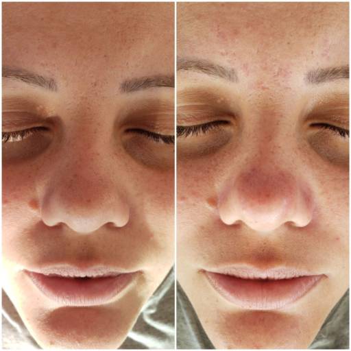 Microagulhamento Facial em Bauru