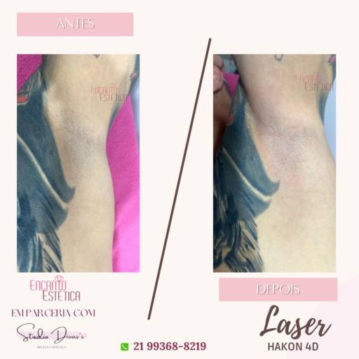  Depilação a Laser - Conquiste a Pele Lisa e Livre de Pelos no Rio de Janeiro/RJ por Encanto Estética