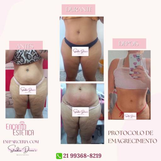Criolipólise - Esculpir o Corpo com Precisão no Rio de Janeiro/RJ por Encanto Estética