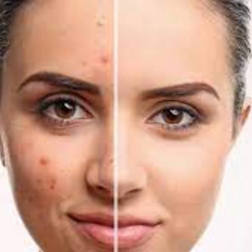 Comprar o produto de Tratamento de acne em Beleza, Estética e Bem Estar pela empresa Vitrine do Corpo | Estética Avançada em Aracaju, SE por Solutudo