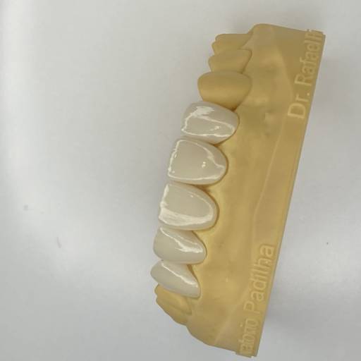 Faceta de resina e cerâmica (lente de contato) por Engel Odontologia Vix