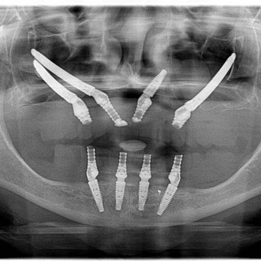Implante Zigomático por Medeiros Odontologia