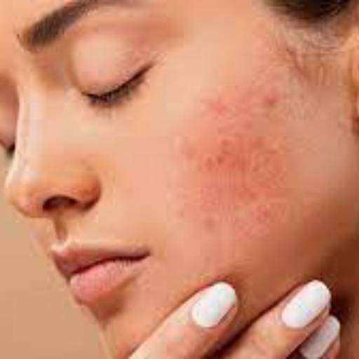 Tratamento de acne por Mappelle Estética