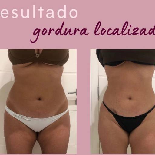 Tratamento Gordura Localizada  por Leticia Morales Conte Fisioterapeuta