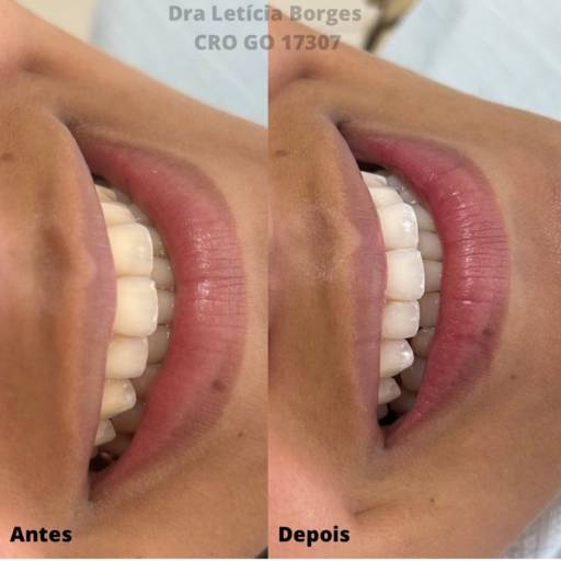 Clareamento dental  por Dra. Leticia Borges