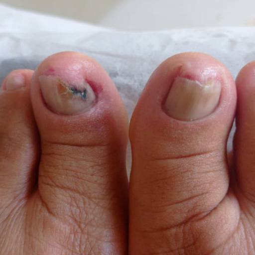 Tratamento de Onicomicose em Franca: Soluções Eficazes - Clínica Roseli Rosendo por Clínica de Podologia Roseli Rosendo