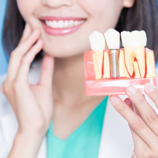 Protocolo Superior com 6 Implantes Pinos – Restauração Total da Arcada Superior – Precisão da Digna Saúde – Ribeirão Preto/SP