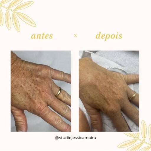 Tratamento melanose solar por Studio Jéssica Maira (Alongamento de cílios) 