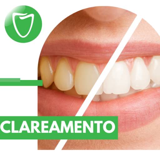 Clareamento profissional para dentes em Itapetininga