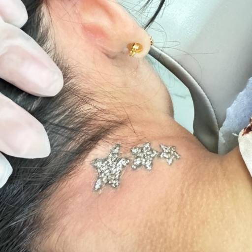 Remoção de Tatuagem