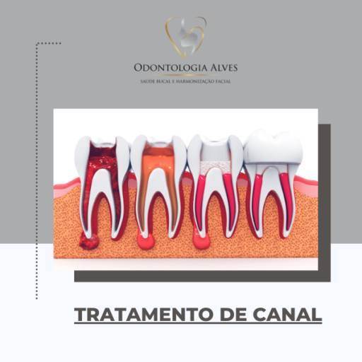 Fazer tratamento de canal em Itapetininga 