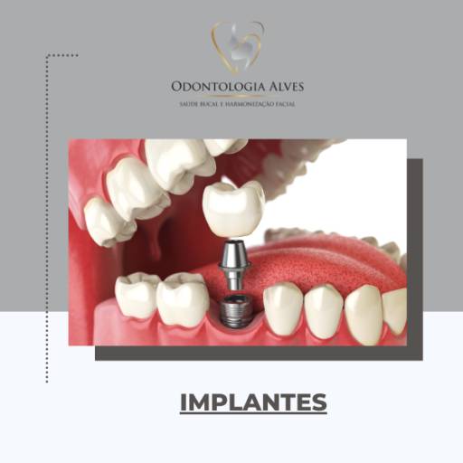 Implante Dentário em Itapetininga