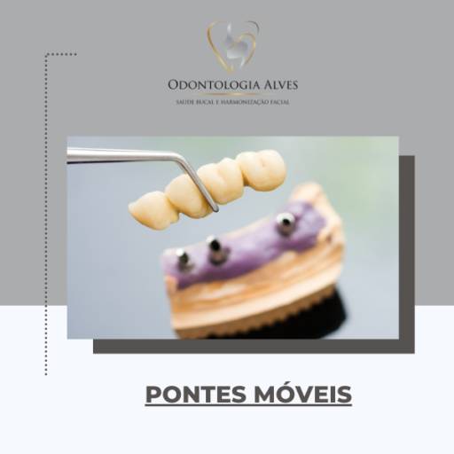 Pontes Dentárias Removíveis