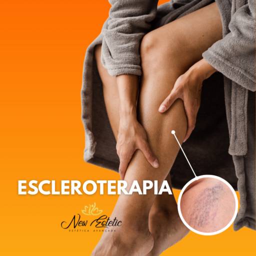 Escleroterapia em Foz do Iguaçu