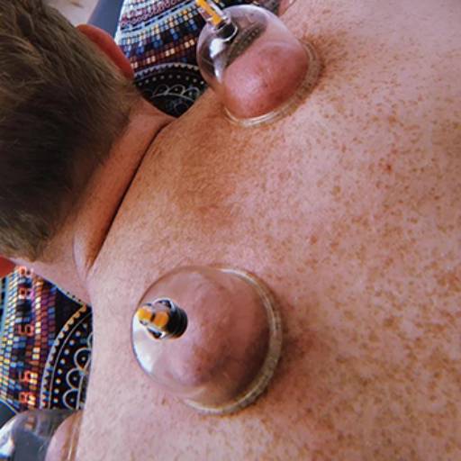 Ventosaterapia por Dra. Rafaela Valensuela | Fisioterapia e Massagem em Americana 